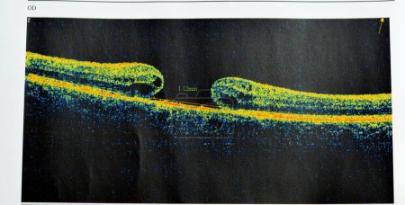 Téléchargez les photos : PTOM de l'œil révèle une membrane épimaculaire faible et un trou maculaire pleine épaisseur impliquant la fovéa, entourant un œdème maculaire diffus montrant peu de changements cystoïdes pour le suivi, mise au point sélective - en image libre de droit