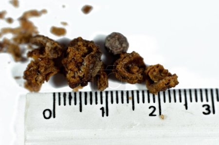 Photo for Nephrolithiasis, irregular brown kidney stones (renal calculus or nephrolith), the stones are different in size after operative ureteroscopy and Laser Lithotripsy and fragmentation, selective focus - Royalty Free Image