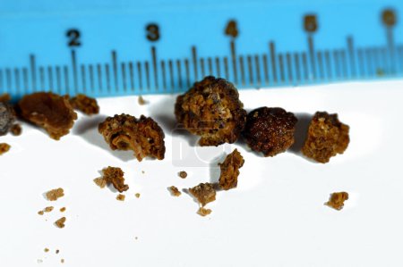 Photo for Nephrolithiasis, irregular brown kidney stones (renal calculus or nephrolith), the stones are different in size after operative ureteroscopy and Laser Lithotripsy and fragmentation, selective focus - Royalty Free Image