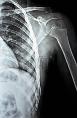 Téléchargez les photos : Plaine x Ray PXR de l'épaule gauche d'une patiente squelettique immature enfant présentant une fracture latérale d'un tiers de la clavicule, fracture de la partie latérale de l'os de la clavicule chez une fillette de 9 ans, foyer sélectif - en image libre de droit