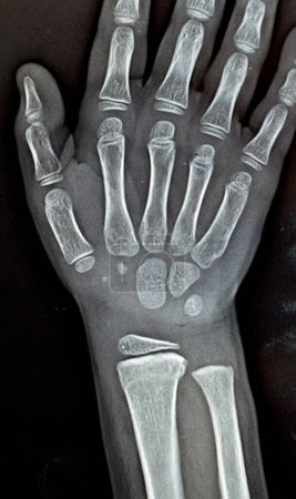 Photo for A PXR plain x ray of right wrist joint of skeletally immature female child patient shows neglected physeal injury of right distal radius bone, Injury of The growth plate, or physis, selective focus - Royalty Free Image