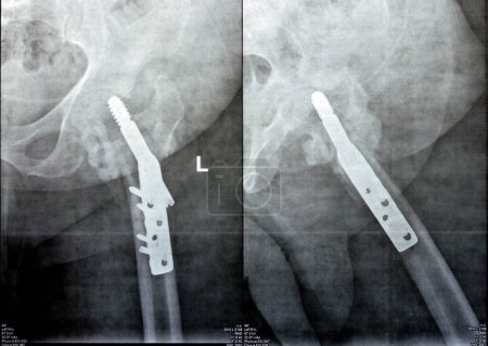 Photo for Left hip trans cervical neck of femur fracture fixated by DHS Dynamic Hip Screw, Plain x ray PXR of an old patient, a femoral head-sparing orthopaedic device, is used to treat femoral neck fractures - Royalty Free Image