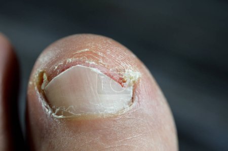 Téléchargez les photos : L'ongle incarné du gros orteil du pied est une condition commune dans laquelle le coin ou le côté d'un ongle se développe dans la chair molle entraîne une douleur, une inflammation de la peau, un gonflement et une infection - en image libre de droit