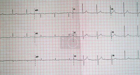Téléchargez les photos : ECG ElectroCardioGraph paper that shows sinus rhythm annormality of right ventricular hypertrophy, Infior T wave due to hypertrophy and ischemia, Annormal ECG study, unconfirmed diagnosis - en image libre de droit