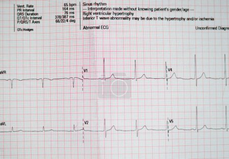 Photo for ECG ElectroCardioGraph paper that shows sinus rhythm abnormality of right ventricular hypertrophy, inferior T wave due to hypertrophy and ischemia, Abnormal ECG study, unconfirmed diagnosis - Royalty Free Image