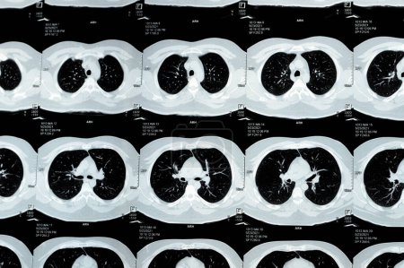 Photo for Multi slice CT scan of the chest showing normal study, normal appearance of the lungs, parenchyma, pulmonary vasculature,  mediastinal structures, no adenopathy, no pleural effusion, no abnormality - Royalty Free Image