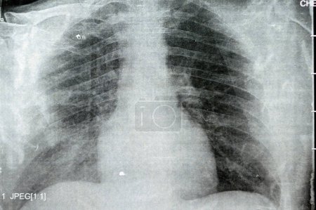 Photo for Plain x ray chest showing infectious pulmonary process pneumonia with right side minimal para-pneumonic effusion, right sided aspiration pneumonia that could be complicated to empyema - Royalty Free Image