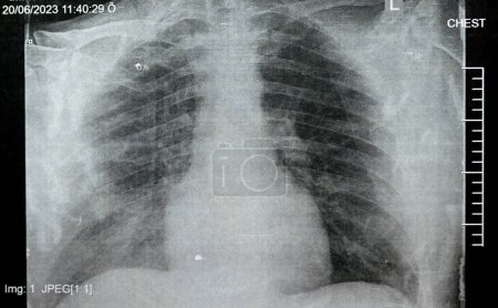 Photo for Plain x ray chest showing infectious pulmonary process pneumonia with right side minimal para-pneumonic effusion, right sided aspiration pneumonia that could be complicated to empyema - Royalty Free Image