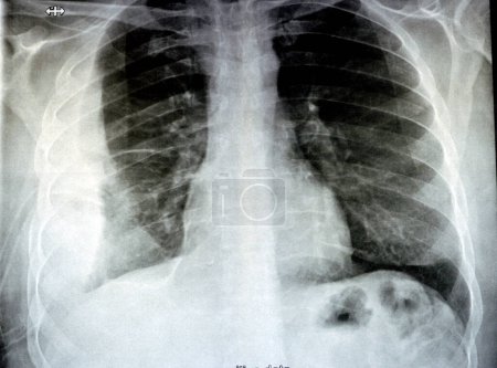 Photo for Plain X ray for a patient with aspiration pneumonia right lung, empyema, pleural effusion after insertion of a chest thoracostomy tube to drain the pus and the fluids with a slight improvement - Royalty Free Image