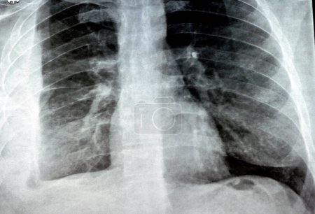 Photo for Plain X ray for a patient with aspiration pneumonia right lung, empyema, pleural effusion after insertion of a chest thoracostomy tube to drain the pus and the fluids with a slight improvement - Royalty Free Image