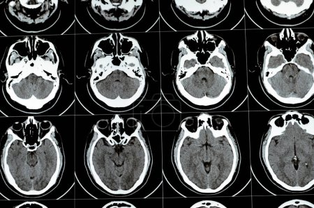 Téléchargez les photos : Scan CT multi-tranches du cerveau montrant un grand tronc cérébral et un hématome semi-ovale central droit, des structures fossales postérieures normales, une taille normale du système ventriculaire et des structures médianes centrales - en image libre de droit