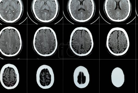 Téléchargez les photos : Scan CT multi-tranches du cerveau montrant un grand tronc cérébral et un hématome semi-ovale central droit, des structures fossales postérieures normales, une taille normale du système ventriculaire et des structures médianes centrales - en image libre de droit