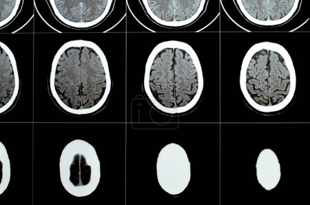 Foto de Tomografía computarizada multicorte del cerebro que muestra hematoma semiovalado de tronco encefálico grande y centro derecho, estructuras normales de fosa posterior, tamaño normal del sistema ventricular y estructuras centrales de línea media - Imagen libre de derechos