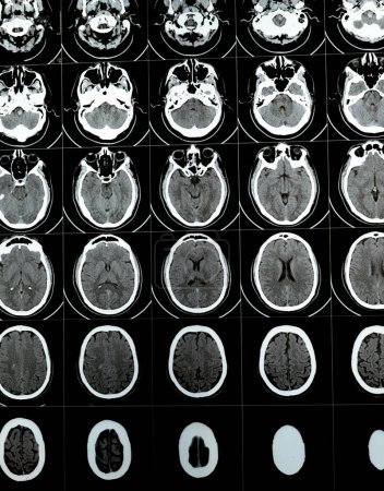 Foto de Tomografía computarizada multicorte del cerebro que muestra hematoma semiovalado de tronco encefálico grande y centro derecho, estructuras normales de fosa posterior, tamaño normal del sistema ventricular y estructuras centrales de línea media - Imagen libre de derechos