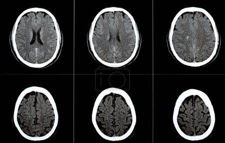Téléchargez les photos : TDM cérébral montrant un cavernome du tronc cérébral, une anomalie veineuse du développement semi-ovale du centrum droit, un hématome intra-cérébral, une lésion hypodense faible dans la médulla oblongata et une jonction pontomédullaire - en image libre de droit
