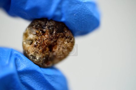 Photo for Large gallstone removed surgically after laparoscopic cholecystectomy, Gallstones are hardened deposits of digestive fluid that can form in gallbladder with two types, cholesterol and pigment stones - Royalty Free Image