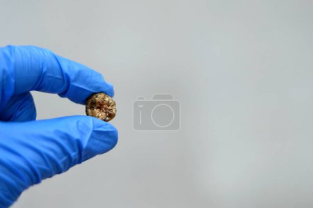 Photo for Large gallstone removed surgically after laparoscopic cholecystectomy, Gallstones are hardened deposits of digestive fluid that can form in gallbladder with two types, cholesterol and pigment stones - Royalty Free Image