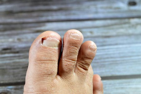 Photo for Bleeding of the big toe of the right foot, insult of the foot toe resulting in a bleeding wound that needs care and bandage, blood on toenail that needs medical attention after removing ingrown nail - Royalty Free Image