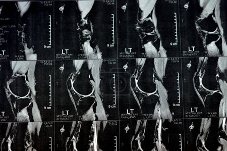 Photo for MRI of left knee joint showing minimal joint effusion, PHMM Posterior Horn Medial Meniscus degeneration, ACL anterior cruciate ligament mild sprain, normal MCL, LM, LCL, ligaments, vessels and nerves - Royalty Free Image