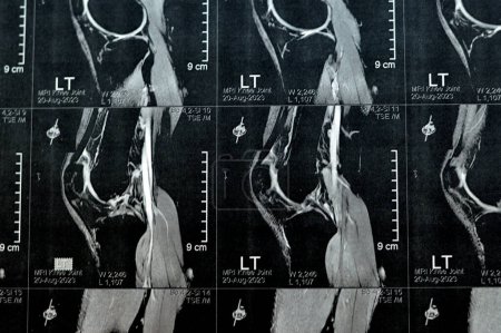 Photo for MRI of left knee joint showing minimal joint effusion, PHMM Posterior Horn Medial Meniscus degeneration, ACL anterior cruciate ligament mild sprain, normal MCL, LM, LCL, ligaments, vessels and nerves - Royalty Free Image