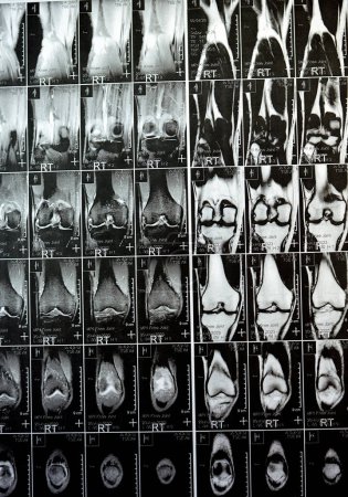 Téléchargez les photos : IRM du genou droit montrant un léger épanchement articulaire, avec d'autres résultats normaux de PHMM, ACL, MCL, LCL, LM, ligaments, rotule, tendons, nerfs, muscles, vaisseaux, PCL, coussin adipeux Hoffa, tissus mous - en image libre de droit