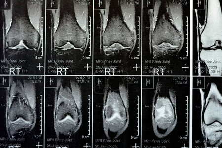 Photo for MRI of the right knee showing mild joint effusion, with normal other findings of PHMM, ACL, MCL, LCL, LM, ligaments, patella, tendons, nerves, muscles, vessels, PCL, Hoffa fat pad, soft tissues - Royalty Free Image