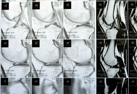 Téléchargez les photos : IRM du genou droit montrant un léger épanchement articulaire, avec d'autres résultats normaux de PHMM, ACL, MCL, LCL, LM, ligaments, rotule, tendons, nerfs, muscles, vaisseaux, PCL, coussin adipeux Hoffa, tissus mous - en image libre de droit