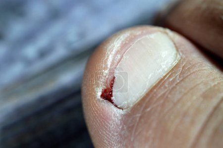 Photo for Bleeding of the big toe of the right foot, insult of the foot toe resulting in a bleeding wound that needs care and bandage, blood on toenail that needs medical attention after removing ingrown nail - Royalty Free Image