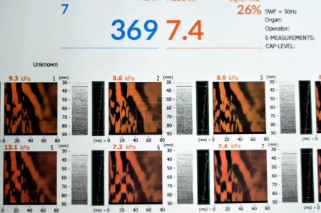 Foto de El estudio de fibrogammagrafía del hígado reveló F2 para rigidez hepática, S3 para esteatosis hepática, lectura de fibrosis 7,4 kPa, parámetro de atenuación de captura CAP 369 dBm, elastografía por ultrasonido - Imagen libre de derechos