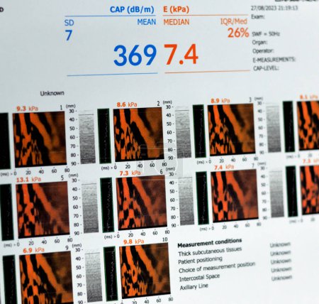 Téléchargez les photos : L'examen par fibroscopie du foie a révélé F2 pour la rigidité du foie, S3 pour la stéatose hépatique, lecture de la fibrose 7,4 kPa, paramètre d'atténuation de capture CAP 369 dBm, élastographie par ultrasons - en image libre de droit