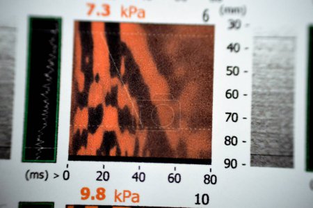 Foto de El estudio de fibrogammagrafía del hígado reveló F2 para rigidez hepática, S3 para esteatosis hepática, lectura de fibrosis 7,4 kPa, parámetro de atenuación de captura CAP 369 dBm, elastografía por ultrasonido - Imagen libre de derechos