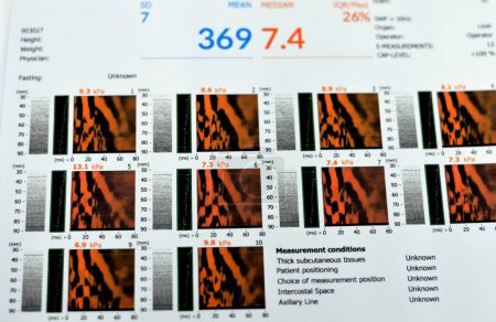 Téléchargez les photos : L'examen par fibroscopie du foie a révélé F2 pour la rigidité du foie, S3 pour la stéatose hépatique, lecture de la fibrose 7,4 kPa, paramètre d'atténuation de capture CAP 369 dBm, élastographie par ultrasons - en image libre de droit