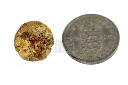 Photo for Large gallstone removed surgically after laparoscopic cholecystectomy, Gallstones are hardened deposits of digestive fluid that can form in gallbladder in comparison to a round coin to show size - Royalty Free Image