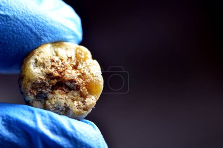 Large gallstone removed surgically after laparoscopic cholecystectomy, Gallstones are hardened deposits of digestive fluid that can form in gallbladder with two types, cholesterol and pigment stones