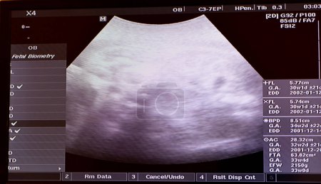 Photo for Ultrasonography on the uterus of a pregnant woman showing a healthy fetus, maternal ultrasound during pregnancy, pregnancy follow up and fetus health concept, ultrasonogram medical checkup - Royalty Free Image