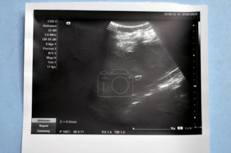 Photo for Abdominal Ultrasonography shows 6mm small echogenic calculus 6mm in the right lower calyx, 8mm stone in the left middle calyx, no back pressure, calyceal dilatation or cystic changes, selective focus - Royalty Free Image