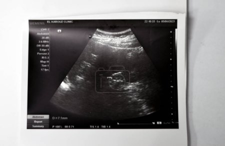 Photo for Cairo, Egypt, September 26 2023: Abdominal Ultrasonography shows 7mm small echogenic calculus in the right lower calyx, 6mm stone in the left middle calyx, no back pressure, calyceal dilatation - Royalty Free Image