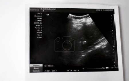 Photo for Cairo, Egypt, September 26 2023: Abdominal Ultrasonography shows 6mm small echogenic calculus 6mm in the right lower calyx, 8mm stone in the left middle calyx, no back pressure, calyceal dilatation - Royalty Free Image
