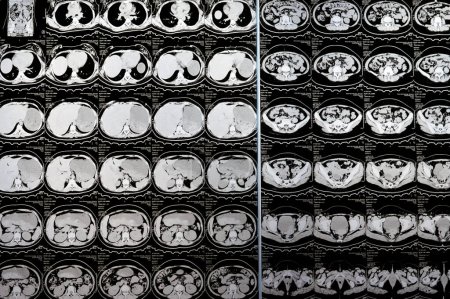 Foto de El Cairo, Egipto, 3 de octubre de 2023: La tomografía computarizada multicorte del abdomen y la pelvis muestra quiste ovárico derecho de 3 x 3 cm, distensión gaseosa colónica, no se han detectado cálculos urinarios ni cálculos considerables - Imagen libre de derechos