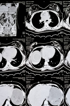 Foto de El Cairo, Egipto, 3 de octubre de 2023: La tomografía computarizada multicorte del abdomen y la pelvis muestra quiste ovárico derecho de 3 x 3 cm, distensión gaseosa colónica, no se han detectado cálculos urinarios ni cálculos considerables - Imagen libre de derechos
