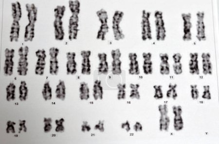 Foto de Cariotipo femenino normal, 46 XX, muestra recogida de sangre periférica, un cariotipo es la apariencia general del conjunto completo de cromosomas en las células de una especie o en un órgano individual - Imagen libre de derechos