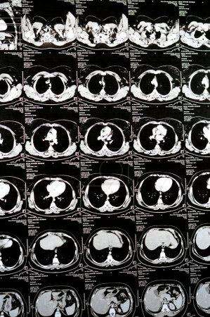 Foto de Cairo, Egipto, 15 de octubre de 2023: TC escanea cortes axiales a través del pecho con inyección de contraste que muestra bajo grado de reacción inflamatoria, vasos parenquimatosos prominentes, pared septal y bronquial engrosada - Imagen libre de derechos