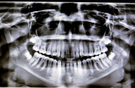 Photo for A panoramic radiograph of a girl fracture of the jawbone after a direct trauma to the left side, a panoramic scanning dental X-ray of the upper and lower jaw, shows a two-dimensional view - Royalty Free Image