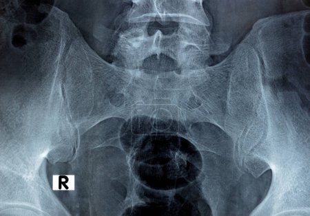Photo for Sacroiliac joint digital radiograph examination X-ray reveals preserved sacroiliac joints spaces and smooth articular surfaces, low back pain concept, selective focus of X ray on Sacro iliac joints - Royalty Free Image