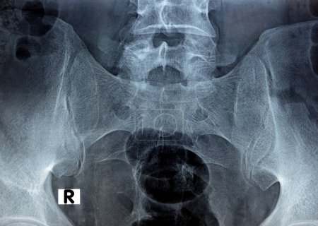 Photo for Sacroiliac joint digital radiograph examination X-ray reveals preserved sacroiliac joints spaces and smooth articular surfaces, low back pain concept, selective focus of X ray on Sacro iliac joints - Royalty Free Image