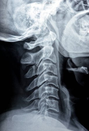 Photo for Plain X ray of cervical spine revealed straightened cervical curve, spondylosis osteophytic lipping of C3, C4, C5 vertebral end plates, narrow disc spaces, ligamentous calcification opposing C4, C5 - Royalty Free Image
