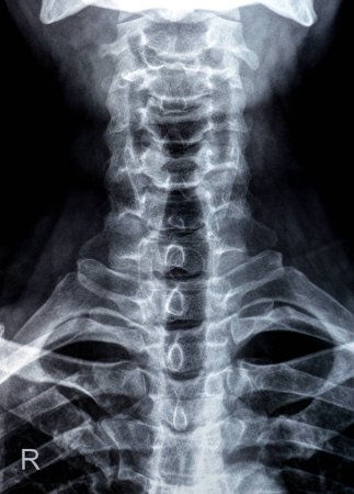 Photo for Plain X ray of cervical spine revealed straightened cervical curve, spondylosis osteophytic lipping of C3, C4, C5 vertebral end plates, narrow disc spaces, ligamentous calcification opposing C4, C5 - Royalty Free Image