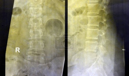 Foto de La columna lumbosacra de rayos X simples reveló deformidad escoliótica leve y enderezada de la columna vertebral, cambios espondilóticos, esacroilitis bilateral, estrechamiento leve de los espacios de disco L4-L5, L5- S1 - Imagen libre de derechos