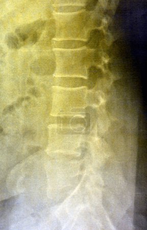 Photo for Plain X ray lumbosacral spine revealed straightened, mild scoliotic deformity of  lumber spine, spondylotic changes, bilateral Sacroiliitis, mild narrowing of L4-L5, L5- S1 disc spaces - Royalty Free Image