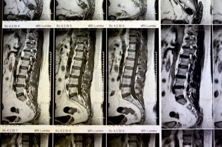 Photo for MRI lumbosacral spine without contrast revealed back muscle spasm, Mild L3-L4, L4-L5 disc lesions, Sacral, L5 and T12 vertebral bodies haemangiomata,  straightened lumber curvature, selective focus - Royalty Free Image